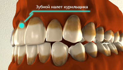 Цвет зубов а2 фото